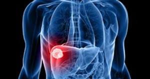 mozhno-li-vylechit-cirroz-pecheni